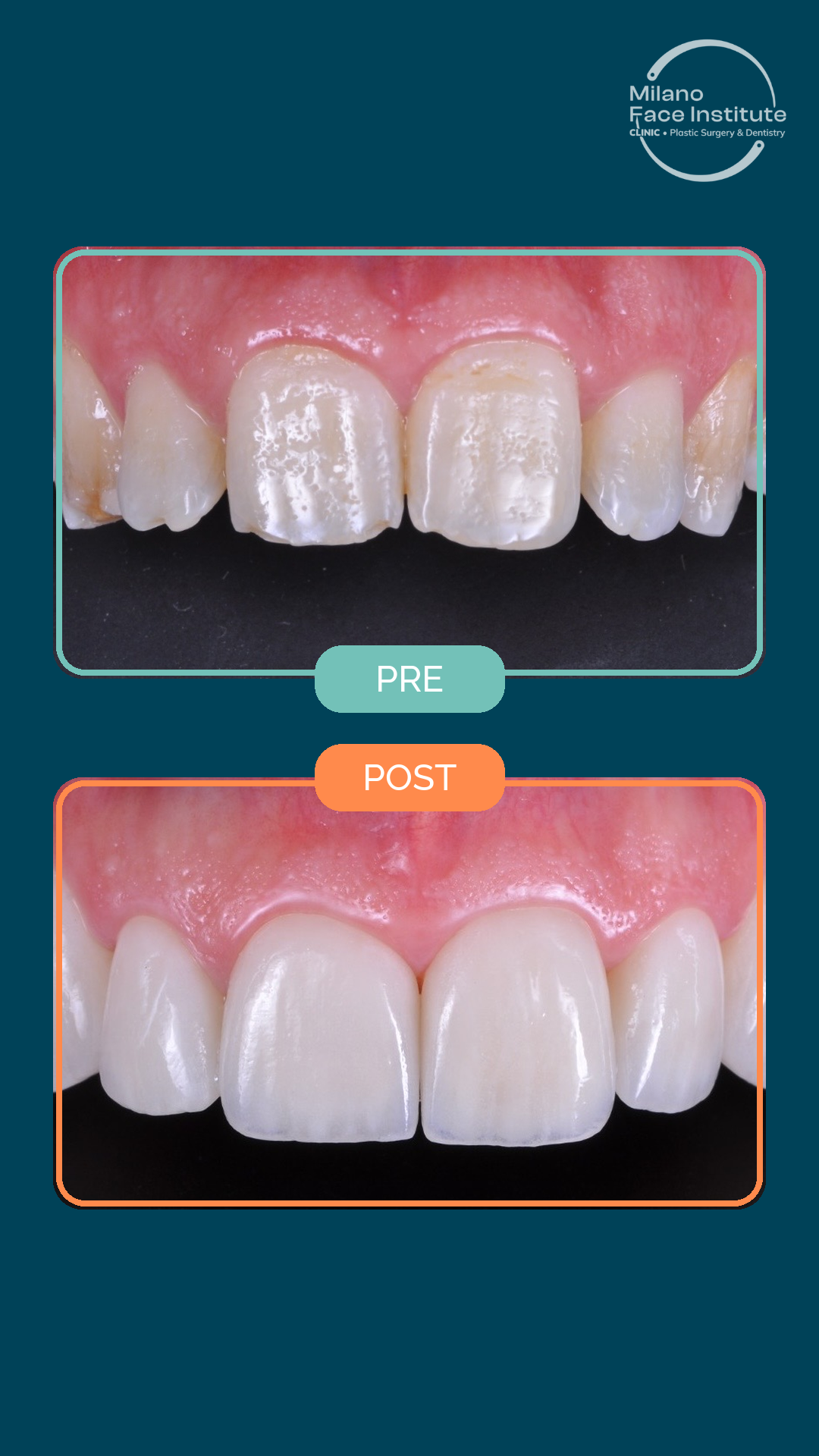 usura smalto faccette ceramica caso clinico